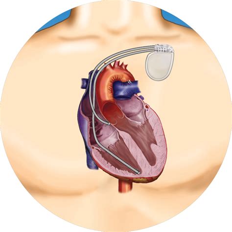 Getting an ICD - Implantable Cardioverter Defibrillator (ICD) | Medtronic