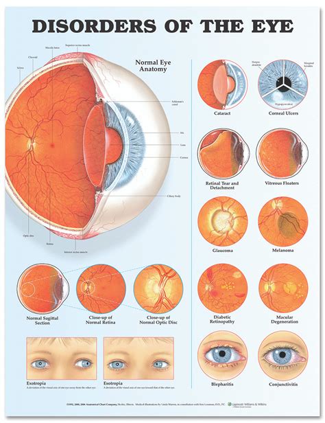 Reference Chart - Disorders of the Eye - Biologyproducts.com