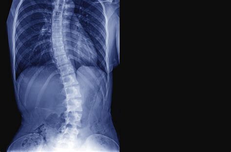 Remission in Axial Spondyloarthritis Unlikely without Biologics