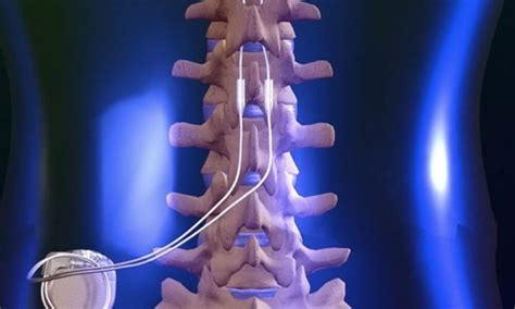 Electrical stimulation to the spine helps paralyzed man walk with ...