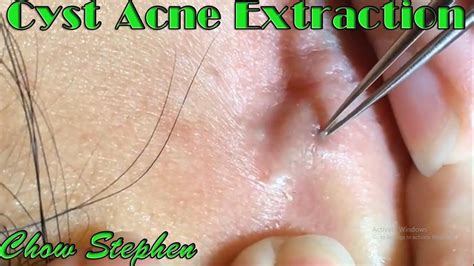 Cyst Acne Removed Behind The Ear - Chow Stephen | Cyst acne, Acne ...