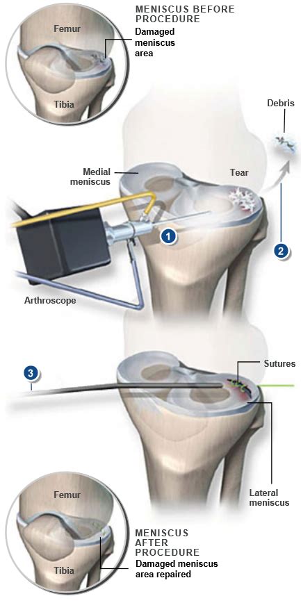 Meniscus Repair | Central Coast Orthopedic Medical Group