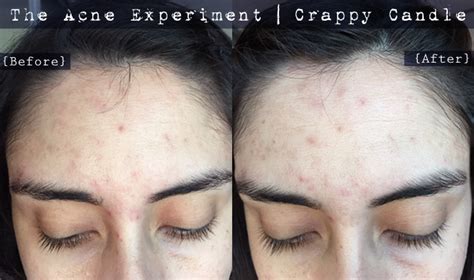 Rosehip Seed Oil Review - The Acne Experiment | Crappy Candle