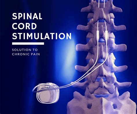 Spinal Cord Stimulation : University Pain and Spine Center ...