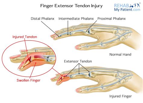 Finger Extensor Tendon Injury | Rehab My Patient