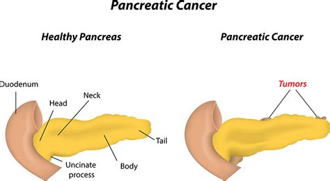 Pancreatic Cancer-Causes,Symptoms,Treatment in Bangalore