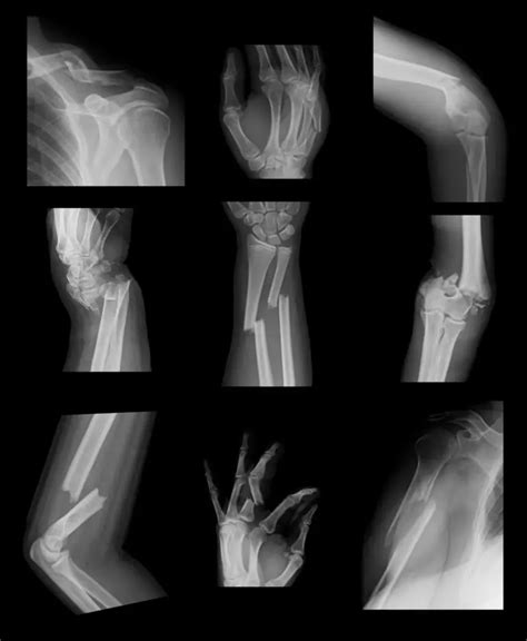 Compound Bone Fracture