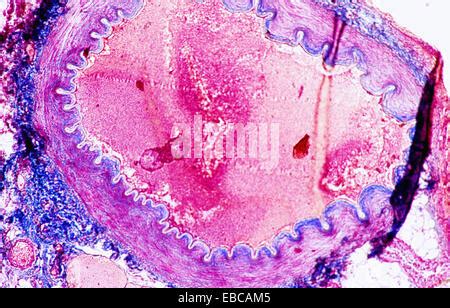 ATHEROMA, HISTOLOGY Stock Photo, Royalty Free Image: 49167196 - Alamy