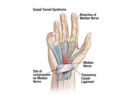 MT Endangerment Sites: 22. Carpal Tunnel