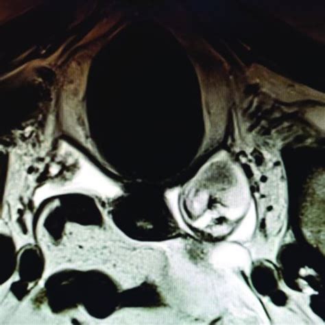 Pelvic MRI showing right ovarian dermoid cyst. | Download Scientific ...