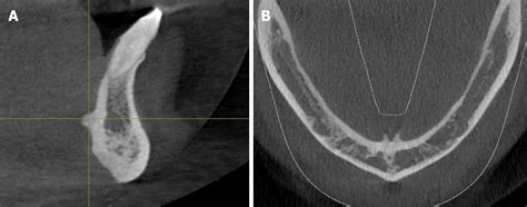 Genial tubercles: Morphological study of the controversial anatomical ...