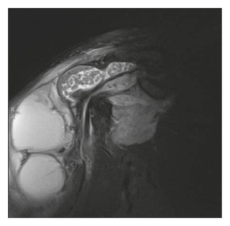 Subdeltoid Bursitis Mri