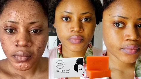 Kojic acid soap side effects | Kojic acid, Skin cleanser products ...