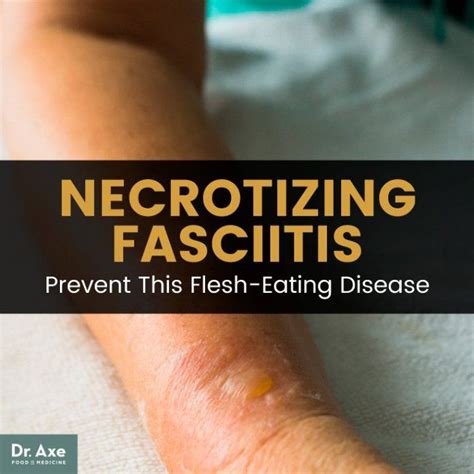 Necrotizing Fasciitis: How to Avoid Flesh-Eating Bacteria | Flesh ...