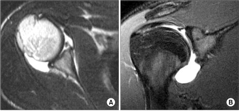 MRI findings showing the Bankart lesion (A) and the superior labrum ...