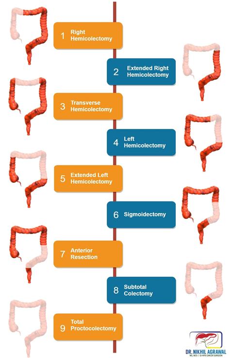 Colon cancer treatment: surgery | Colectomy | Dr. Nikhil Agrawal