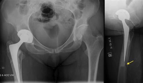 Periprosthetic femur fracture - Radiology at St. Vincent's University ...