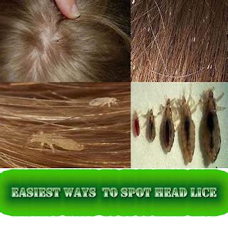 How To Get Rid Of Hair Lice - Birthrepresentative14