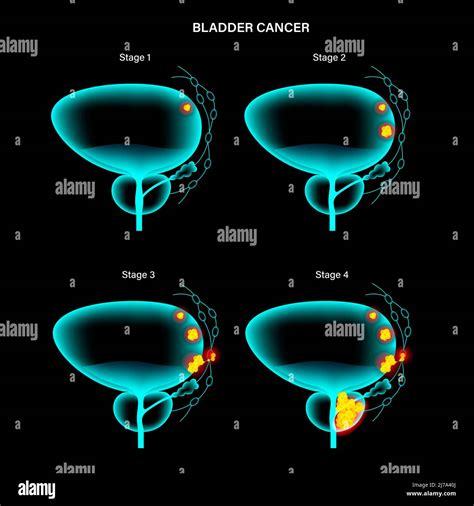 Bladder cancer stages, illustration Stock Photo - Alamy