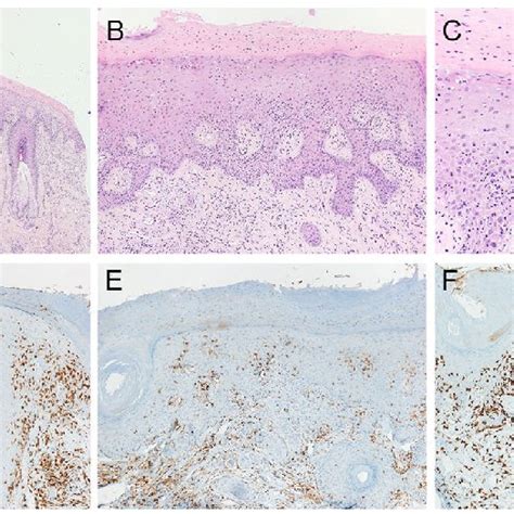 a-c Biopsy of the vulva with lichenoid interface dermatitis: Squamous ...