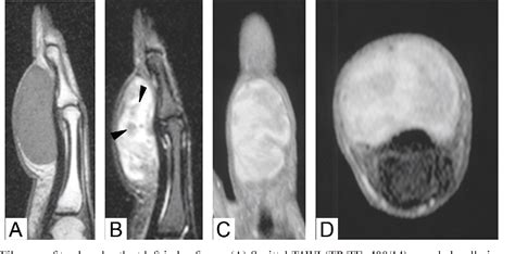 Figure 3 from MRI Findings of Giant Cell Tumor of Tendon Sheath and ...