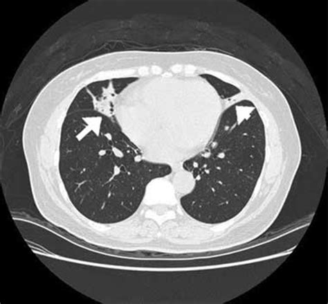 Middle Lobe Syndrome; Brock's Syndrome