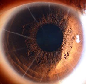 Radial Keratotomy (RK) surgery for myopia | Abbondanza Eye Center ...