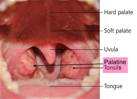 Tonsillitis and Adenoiditis - Causes, Diagnosis and Treatment