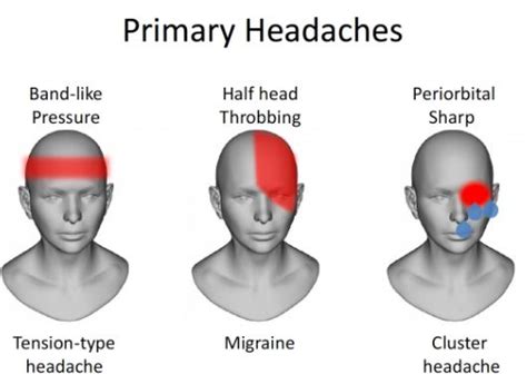 Headache Chart: What Does Headache Location Mean?