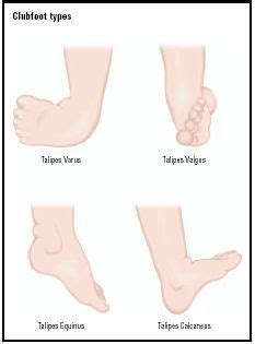 The four varieties of clubfoot. Talipes varus is by far the most common ...