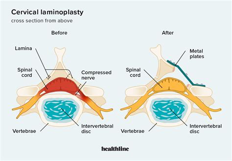 Laminoplasty Surgery: Procedure, Benefits, Risks, Recovery