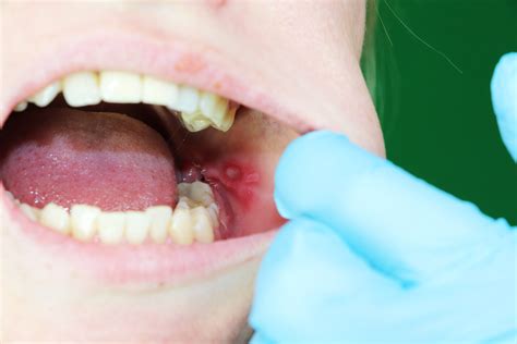 Aphthous Stomatitis - Dentist in Newbury Park