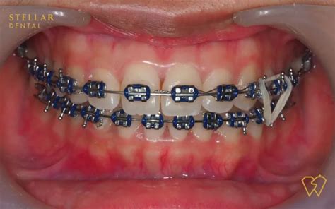 Braces Colors: Top Picks For 2023 - Stellar Dental