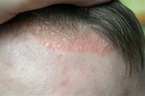 Remedies for Psoriasis of the Scalp - Health n Well.com