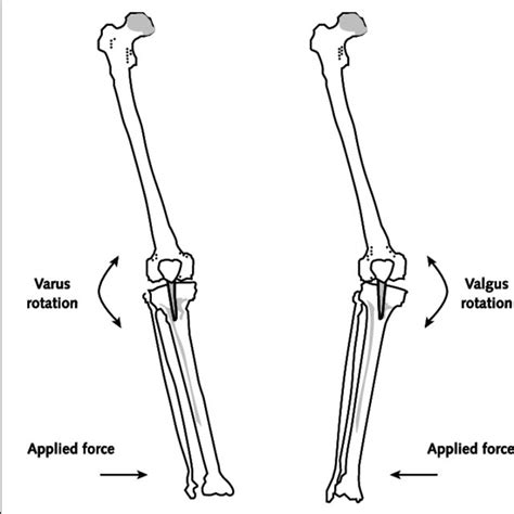 Direction of force application and the resulting motion at the knee in ...