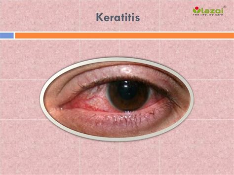 PPT - Keratitis: Causes, Symptoms, Daignosis, Prevention and Treatment ...