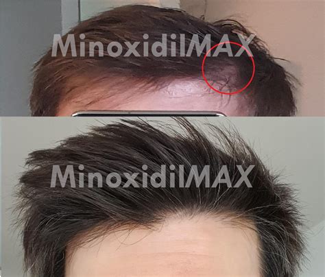 Minoxidil Before And After