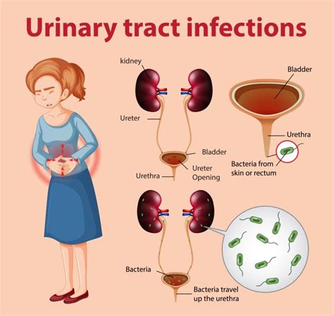 UTI in Queens Creek - East Valley Urology Center of Arizona