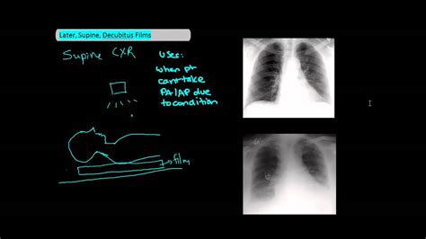 Program that will run x ray from efilm lite - minikaser