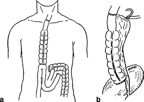 Colonic interposition and supercharge for esophageal reconstruction ...