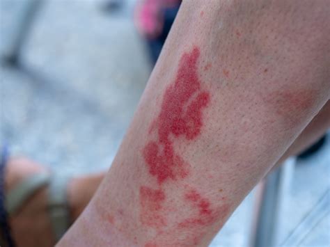 How to Treat and Prevent Disney Rash (Pictures, Tips, and More ...