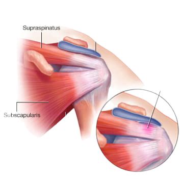 Chondral Injuries - Causes, Symptoms, Treatment & Prevention