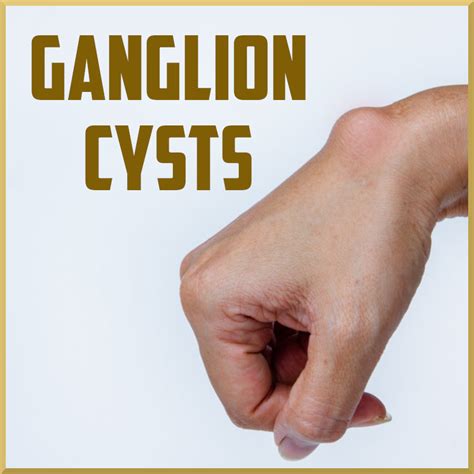 Review of Ganglion Cysts - Sports Medicine Review