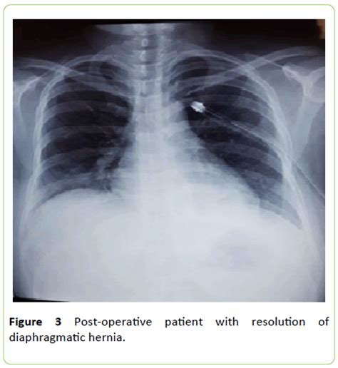 Hernia de Bochdalek: A Challenging Diagnosis | Insight Medical Publishing