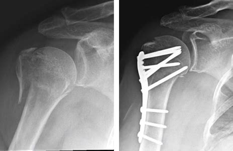 Proximal Humerus Fracture Broken Shoulder Orthopaedic Trauma – NBKomputer