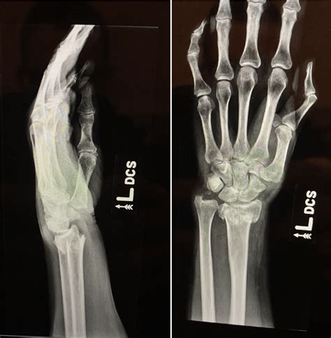 Case: Distal Radius Fracture - Ortho Conditioning