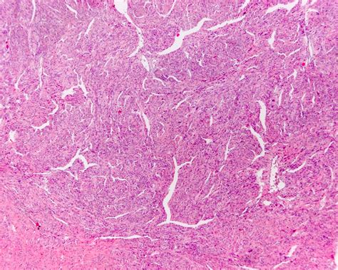 Leiomyosarcoma Uterus Pathology Outlines - Pathology Outlines ...