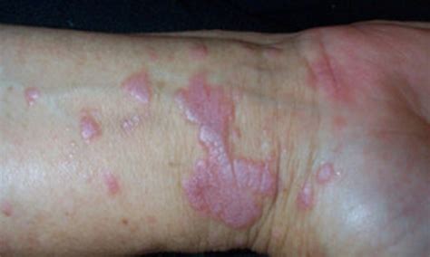 Lichen planus | NHS inform