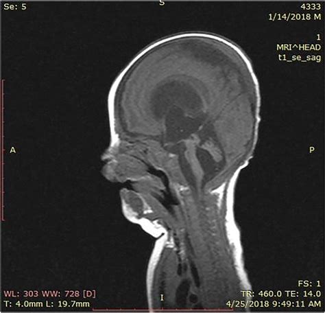 Fig. A2. MRI scan, sagittal view, demonstrating the hypoplasia of the ...