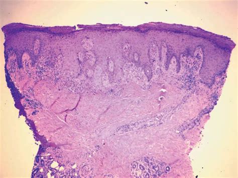 Right ankle biopsy showing a lichenoid dermatitis with superficial and ...